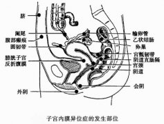 子宫内膜异位症图片